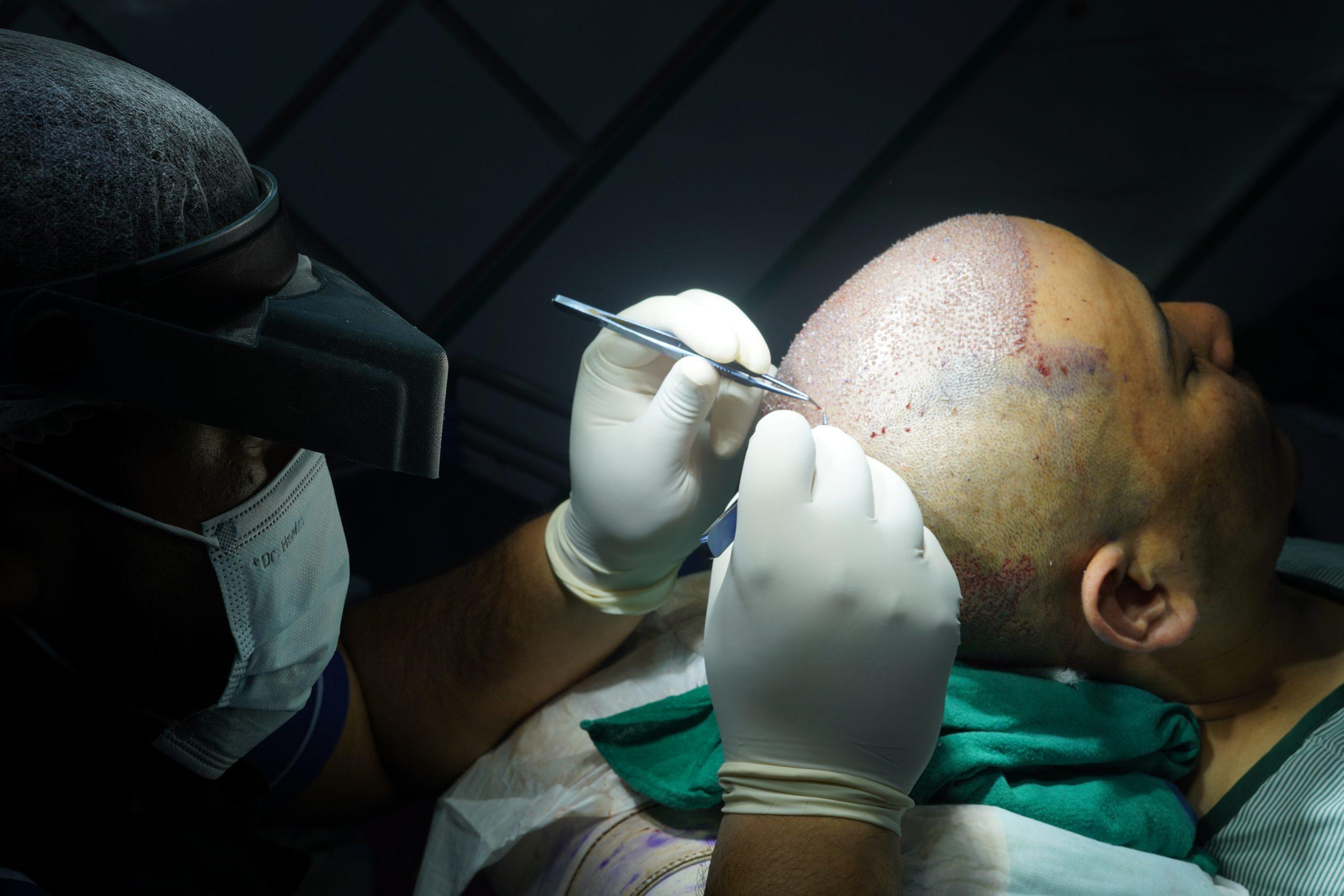 Hair Transplant Nepal Best