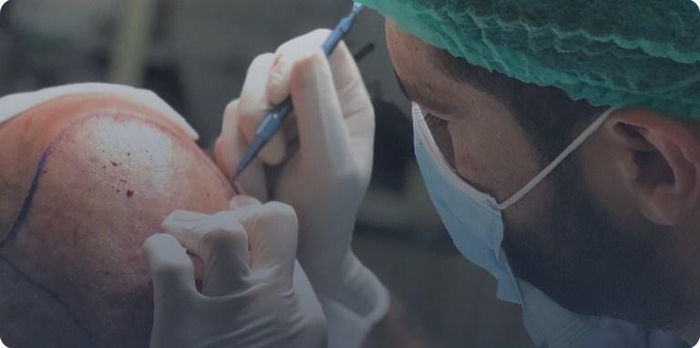 hair transplant surgery