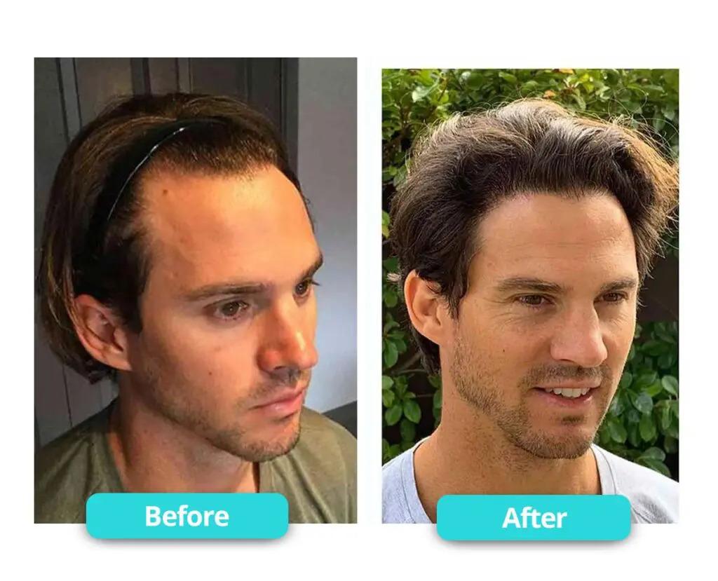 prp before after